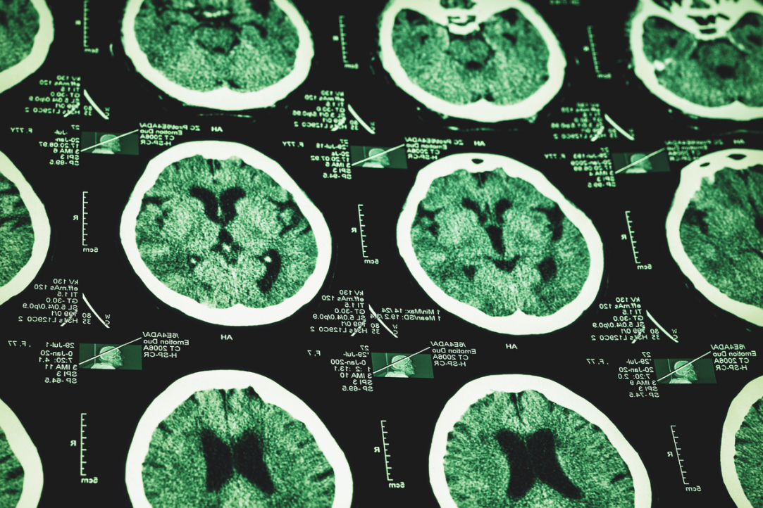 ‘Reading’ with Aphasia Is Easier than ‘Running’ Illustration for news: ‘Reading’ with Aphasia Is Easier than ‘Running’